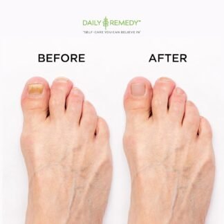 DAILY REMEDY EXTRA STRENGTH Tea Tree Oil Foot Soak w/ Epsom Salt Made in USA Toenails，Athlete's Foot，Itchy Feet，Stubborn Smelly Foot Odor，Pedicure Calluses & Soothes Sore Tired...