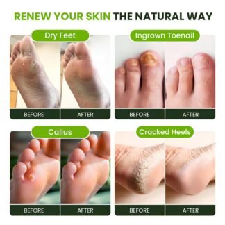 FOOT CURE Tea Tree Oil Foot Soak with Epsom Salt - Best Toenail Fungus Treatment, Athletes Foot & Softens Calluses - Soothes Sore & Tired Feet, Fungal Toe, Foot Odor Scent, Spa...