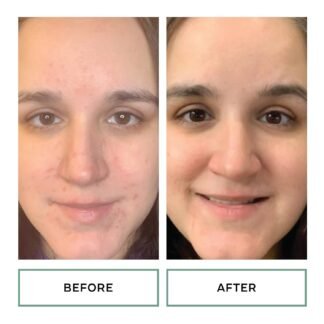 Replenix Gly-Sal Clarifying Acne Pads, 60 Count, Medical-Grade 10% Glycolic Acid & 2% Salicylic Acid Exfoliating Pads for Acne-Prone Skin, Help Clear Blemishes & Refine Pores,...